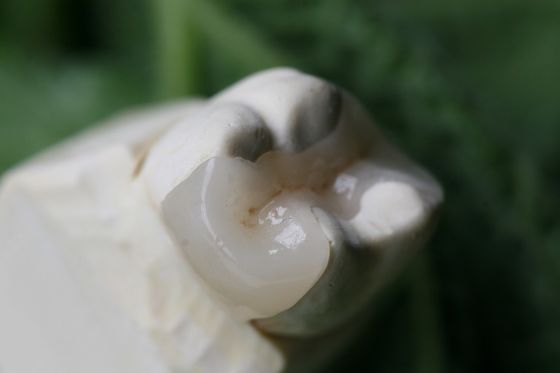 Onlay And Inlay Esthetic Artificial EMAX Dental Crown