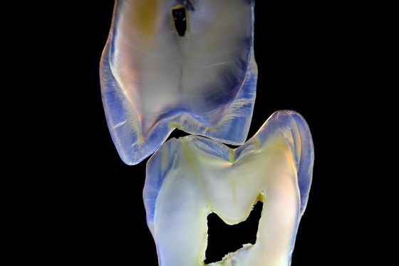 Fixed Prosthetics Permanent Solution EMAX Dental Crown