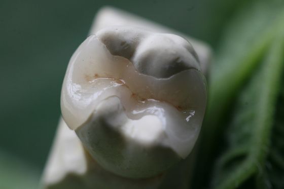 Fixed Prosthetics Permanent Solution EMAX Dental Crown