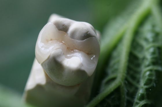 Natural Looking All Porcelain Veneers EMAX Dental Crown