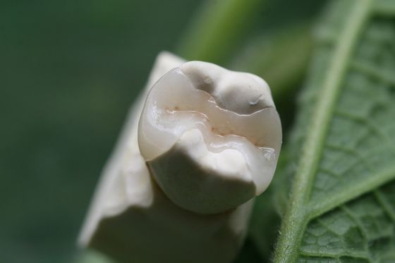 Fixed Prosthetics Permanent Solution EMAX Dental Crown