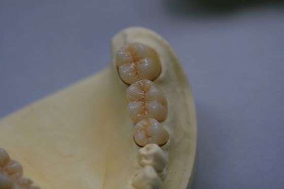 Dental Laboratory Zirconium Oxide Porcelain Zirconia Dental Crown With Ceramic