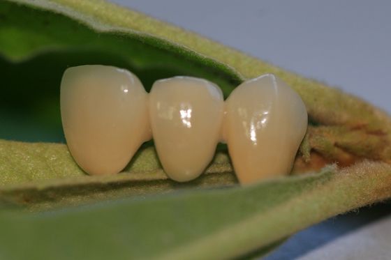 Resin Natural Colour Composite Temporary Crown For Anterior Teeth