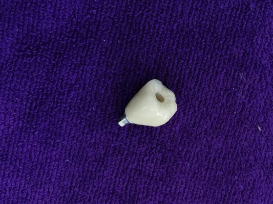 Great Biocompatibility ANKYLOS Dental Implant Supported Crown