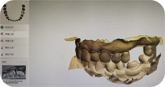 CAD Digital Impression Of Oral Scanning STL Files