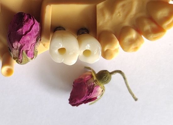 Cemented Implants Crowns Bridges