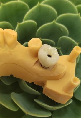 Cemented Implants Crowns Bridges