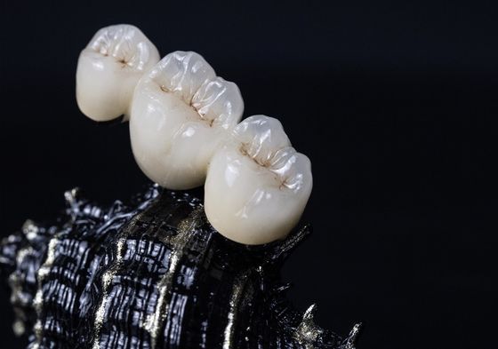 Metal Framework PFM Dental Crown