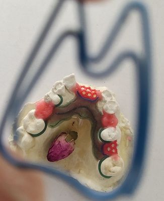 Cr Co Partial Denture Metal Framework
