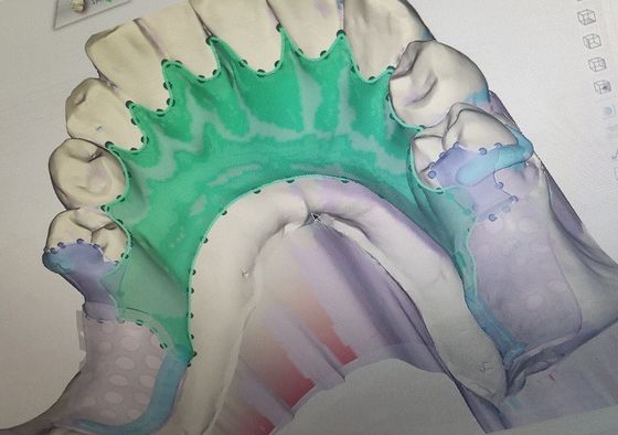 Removable 3D Printed Partial Denture Metal Framework