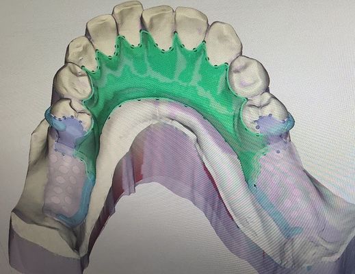 Removable 3D Printed Partial Denture Metal Framework