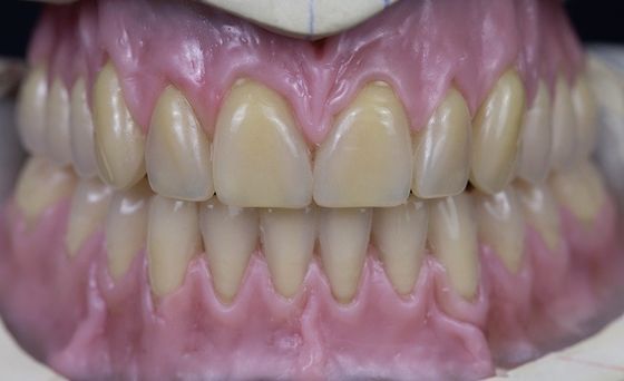 Hot Cured Full Arch Removable Acrylic Full Denture