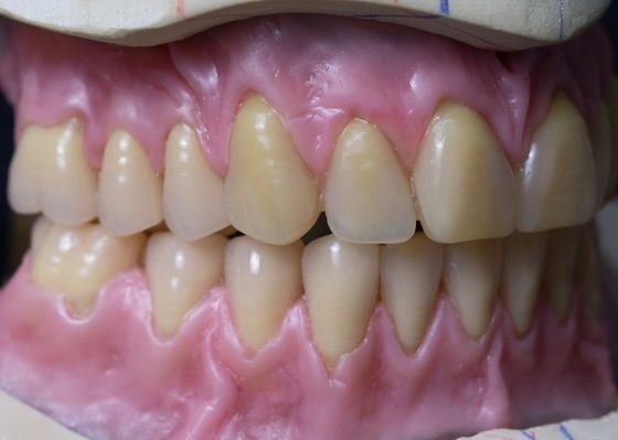 Hot Cured Full Arch Removable Acrylic Full Denture