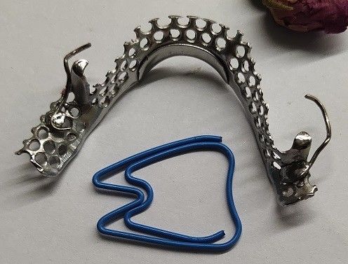Casted Mandibular Arch Partial Denture Metal Framework