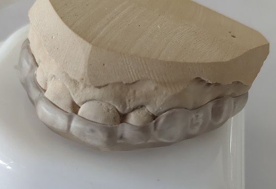 Esthetics Lower Arch Mouth Piece For Teeth Clenching