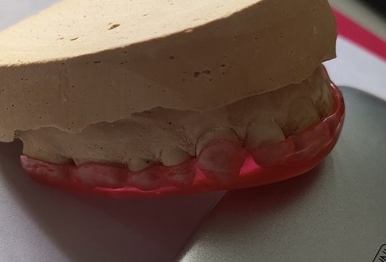 Hard Acrylic Maxillary Arch Stabilization Guard For Bruxism