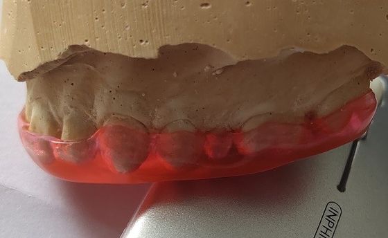 Michigan Guard Trushine Bite Plane For Teeth Grinding