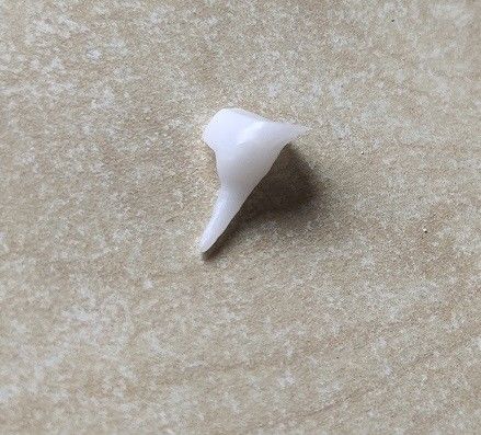 Reinforcing EMAX Porcelain Dental Pin Core