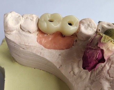 Temporary PMMA Temporary Crown