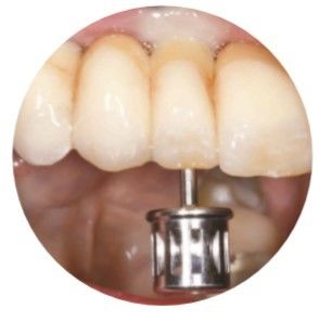 Natural ASC Angled Screw Channel Dental Implants Crown