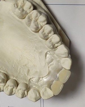 Comfortable Fit ISO13485 RPD Soft Invisible Denture