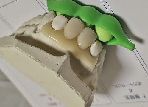 Resin Metal Free Invisible Denture For Allergic Patient