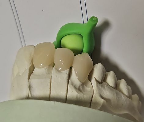 Metal Based Composite Hybrid PMMA Temporary Crown