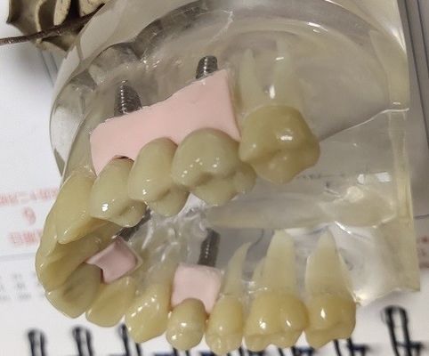 100 Percent Biocompatibility PMMA Provisional Crown