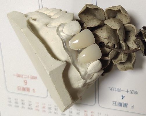 Soft Elastic Nylon Trushine Invisible Denture