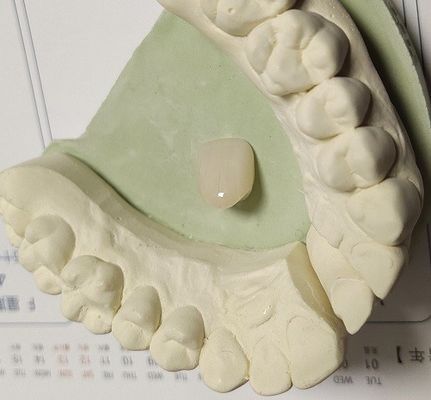 Resin Natural Colour Composite Temporary Crown For Anterior Teeth