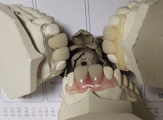 Partial Flexible Invisible Denture For Anterior Teeth