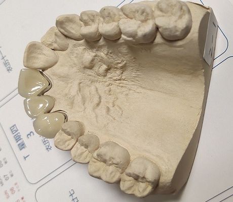 Metal Ceramic Good Fitness PFM Dental Crown