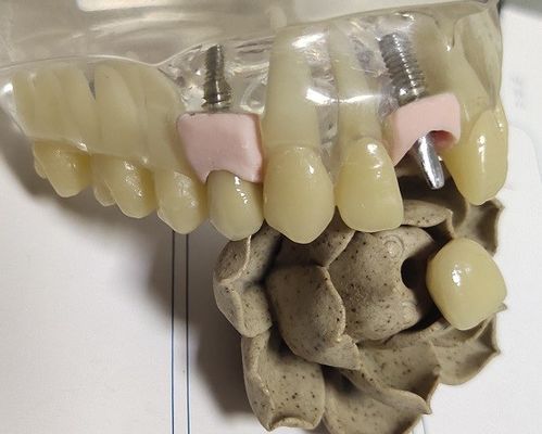 Metal Blank Milling PFM Inner Crown Dental 3D Print
