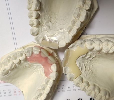 Resin Metal Free Invisible Denture For Allergic Patient