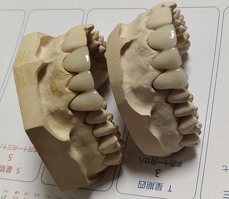 Porcelain CAD CAM PFM Crown