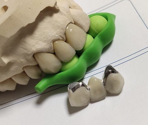 Porcelain CAD CAM PFM Crown