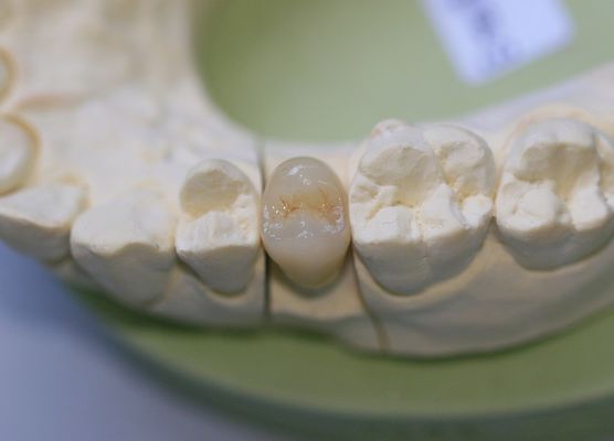 Aesthethics Glass Ceramic EMAX Posterior Crowns For Molars