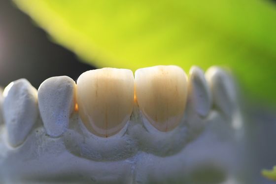 All Ceramic EMAX Porcelain Crown