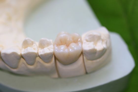 Aesthethics Glass Ceramic EMAX Posterior Crowns For Molars