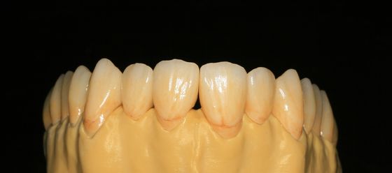Dental Lab Fixed Prosthetics Layered Zirconia Dental Crown For Front Teeth