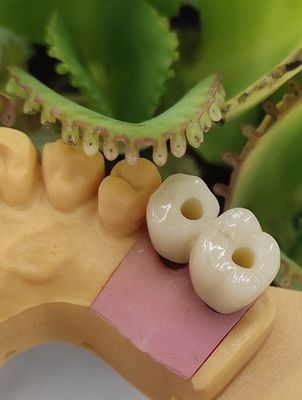 Cemented Solution NOBEL BIOCARE Dental Implants Crown