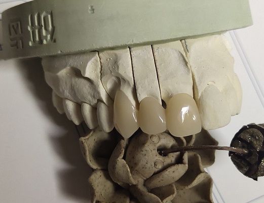 CAD Technique ISO13485 Interim Crown